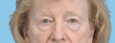 Eye Surgery Before & After Gallery - Patient 661527 - Image 1