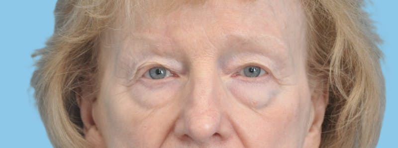 Eye Surgery Before & After Gallery - Patient 661527 - Image 1
