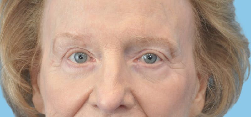 Eye Surgery Before & After Gallery - Patient 661527 - Image 2