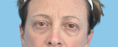 Eye Surgery Before & After Gallery - Patient 235024 - Image 1