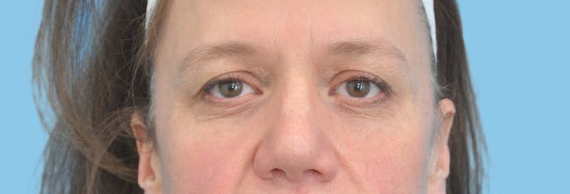 Eye Surgery Before & After Gallery - Patient 139071 - Image 1