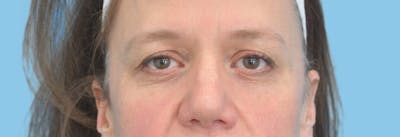 Eye Surgery Before & After Gallery - Patient 139071 - Image 1