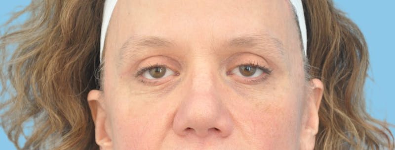 Eye Surgery Before & After Gallery - Patient 139071 - Image 2