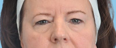 Eye Surgery Before & After Gallery - Patient 575600 - Image 1