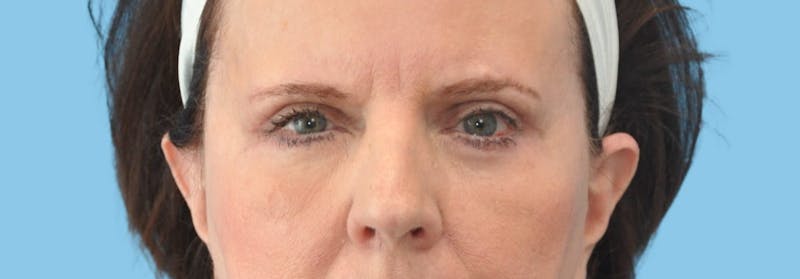 Eye Surgery Before & After Gallery - Patient 575600 - Image 2