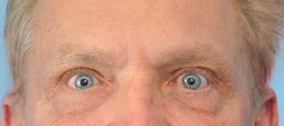 Eye Surgery Before & After Gallery - Patient 378772 - Image 1