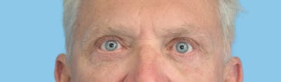 Eye Surgery Before & After Gallery - Patient 378772 - Image 2