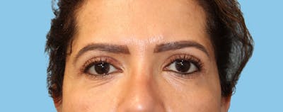 Eye Surgery Before & After Gallery - Patient 175648 - Image 2