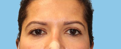 Eye Surgery Before & After Gallery - Patient 175648 - Image 1