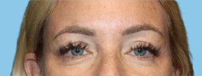 Eye Surgery Before & After Gallery - Patient 378745 - Image 2