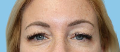 Eye Surgery Before & After Gallery - Patient 378745 - Image 1