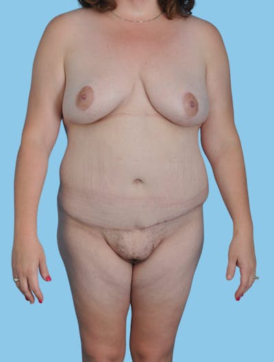 Body Contouring Before & After Gallery - Patient 296564 - Image 2