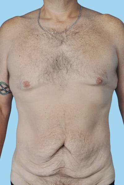 Body Contouring Before & After Gallery - Patient 663067 - Image 1
