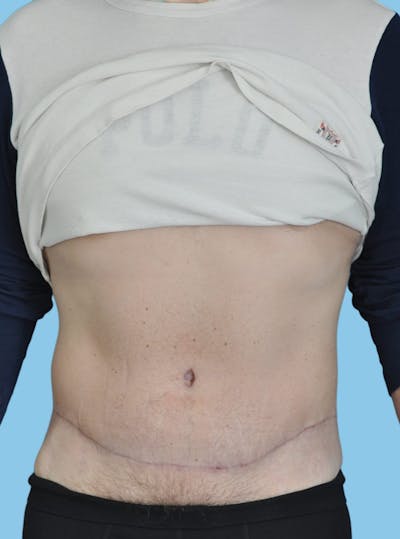 Body Contouring Before & After Gallery - Patient 663067 - Image 2