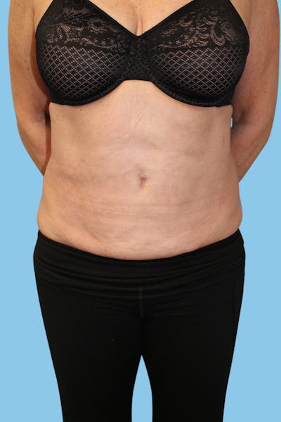 BodyTite Before & After Gallery - Patient 984351 - Image 2