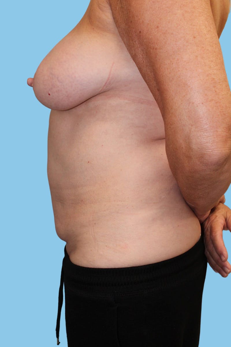 BodyTite Before & After Gallery - Patient 984351 - Image 3