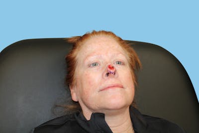 Moh's Closure Before & After Gallery - Patient 424665 - Image 1