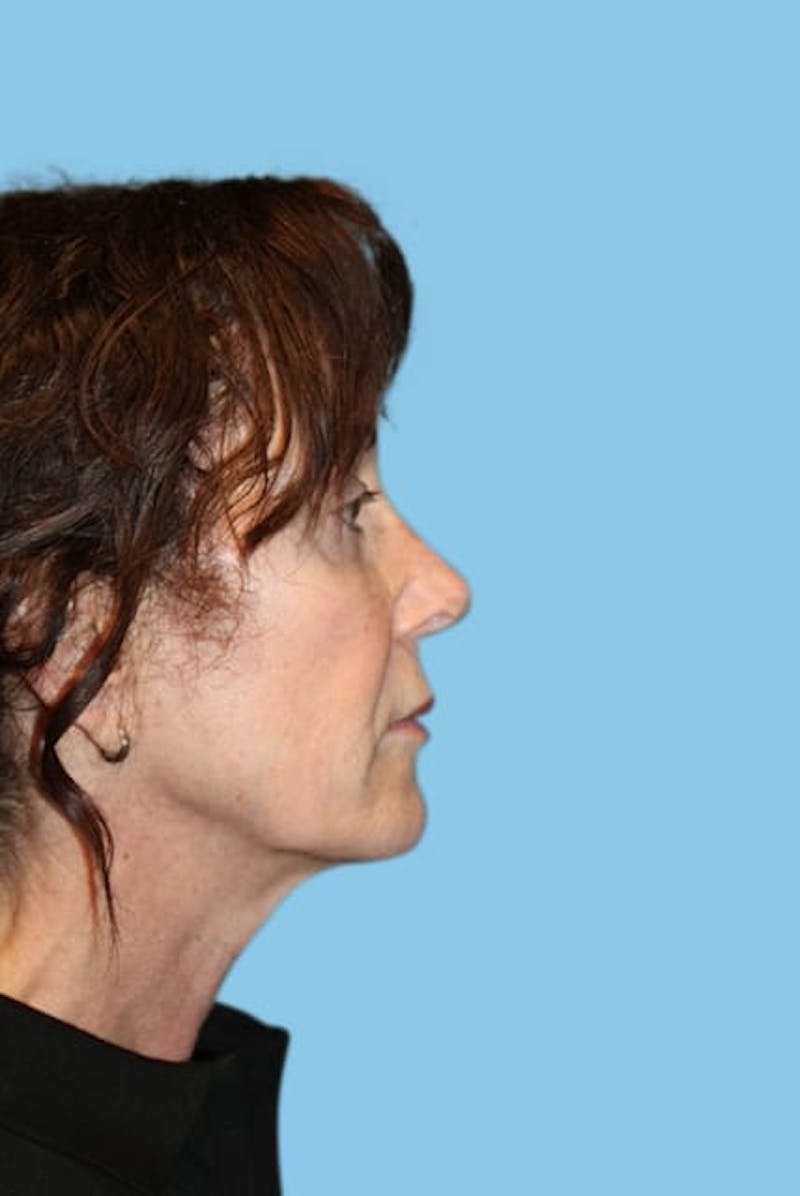 Revision Rhinoplasty Before & After Gallery - Patient 332493 - Image 4
