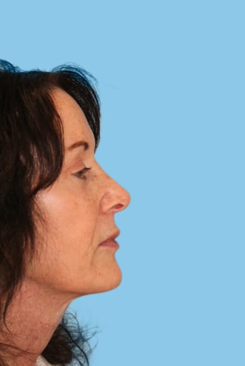Revision Rhinoplasty Before & After Gallery - Patient 332493 - Image 3