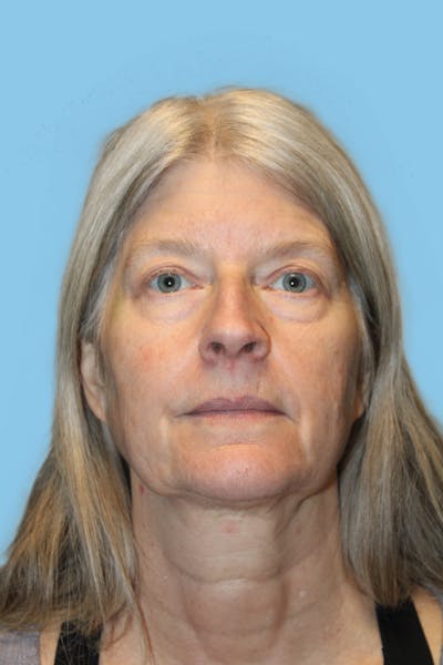 Facelift & Necklift Before & After Gallery - Patient 418294 - Image 1