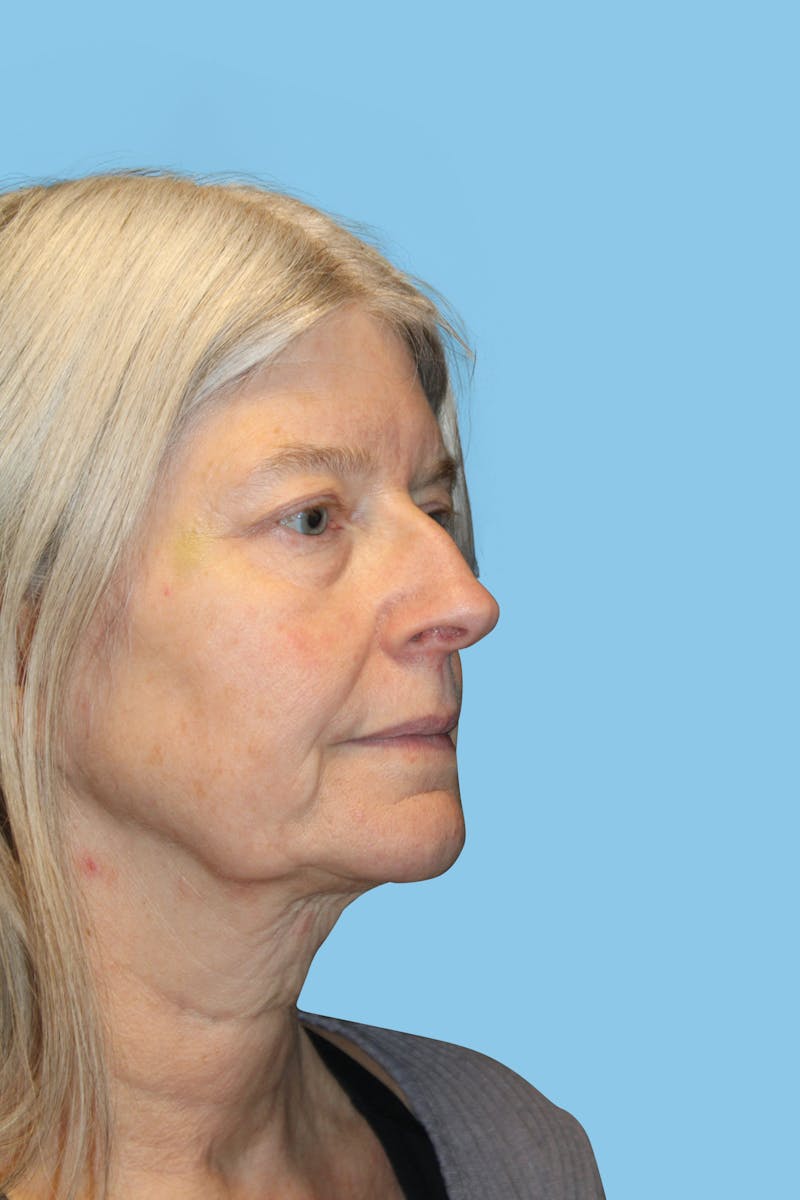 Facelift & Necklift Before & After Gallery - Patient 418294 - Image 3
