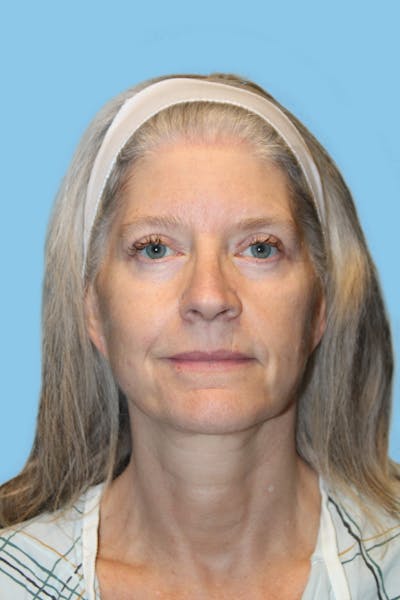 Facelift & Necklift Before & After Gallery - Patient 418294 - Image 2