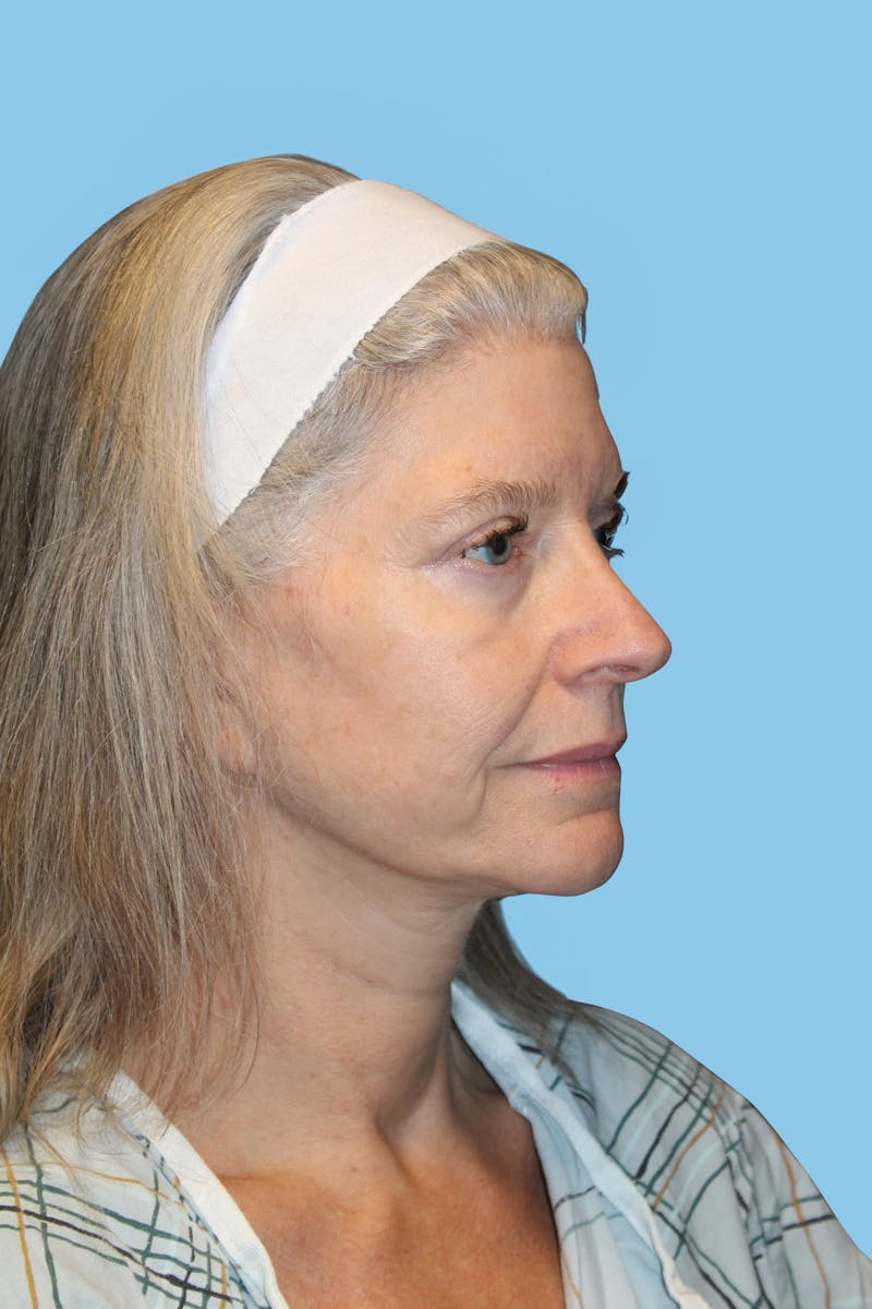 Facelift & Necklift Before & After Gallery - Patient 418294 - Image 4