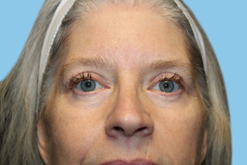 Eye Surgery Before & After Gallery - Patient 272530 - Image 4