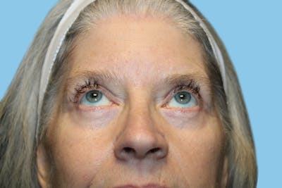 Eye Surgery Before & After Gallery - Patient 272530 - Image 2
