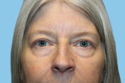 Eye Surgery Before & After Gallery - Patient 272530 - Image 1