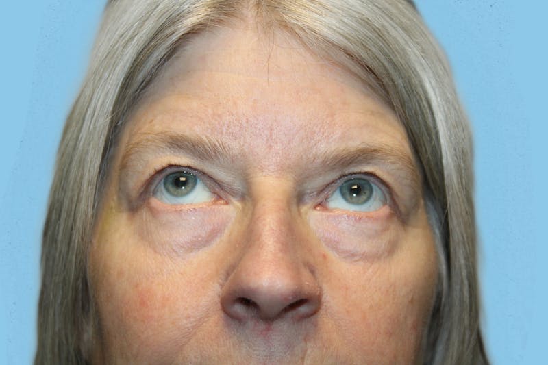 Eye Surgery Before & After Gallery - Patient 272530 - Image 3
