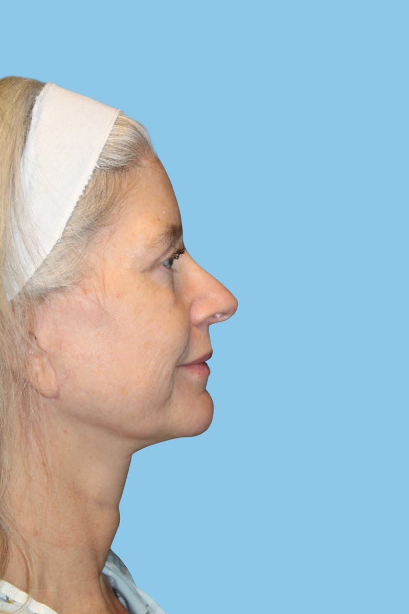 Rhinoplasty Before & After Gallery - Patient 295812 - Image 4