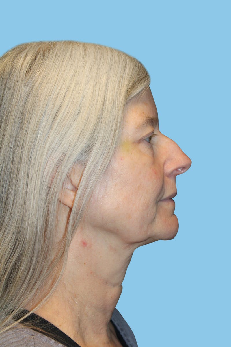 Rhinoplasty Before & After Gallery - Patient 295812 - Image 3