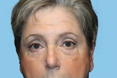 Eye Surgery Before & After Gallery - Patient 169680 - Image 2