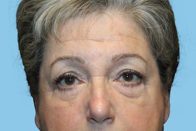 Eye Surgery Before & After Gallery - Patient 169680 - Image 1
