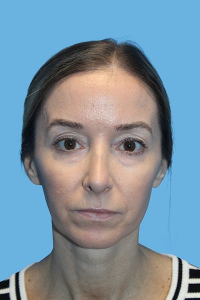 Rhinoplasty Before & After Gallery - Patient 282967 - Image 2