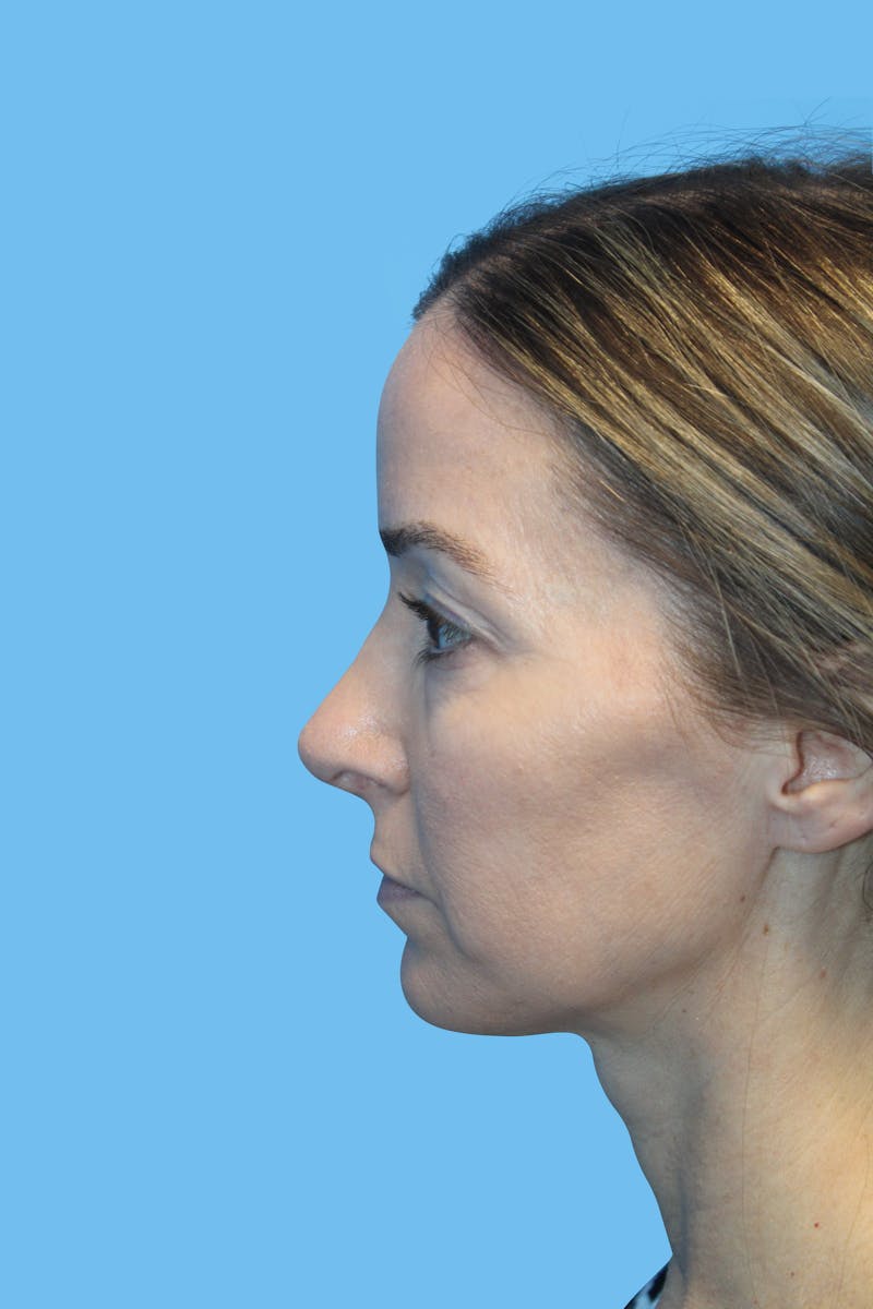 Rhinoplasty Before & After Gallery - Patient 282967 - Image 4