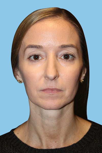 Rhinoplasty Before & After Gallery - Patient 282967 - Image 1