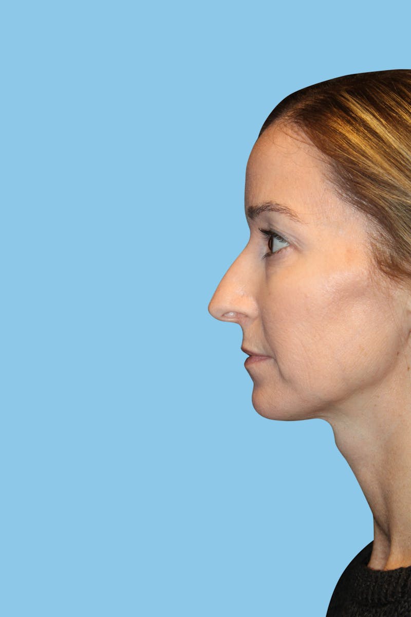 Rhinoplasty Before & After Gallery - Patient 282967 - Image 3