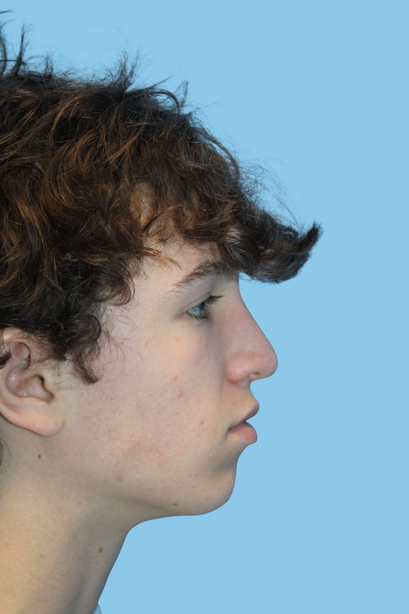 Rhinoplasty Before & After Gallery - Patient 123599 - Image 4