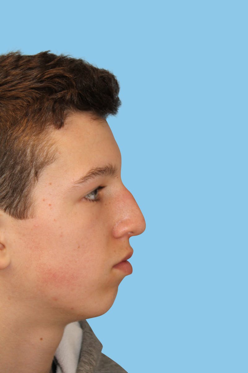 Rhinoplasty Before & After Gallery - Patient 123599 - Image 3