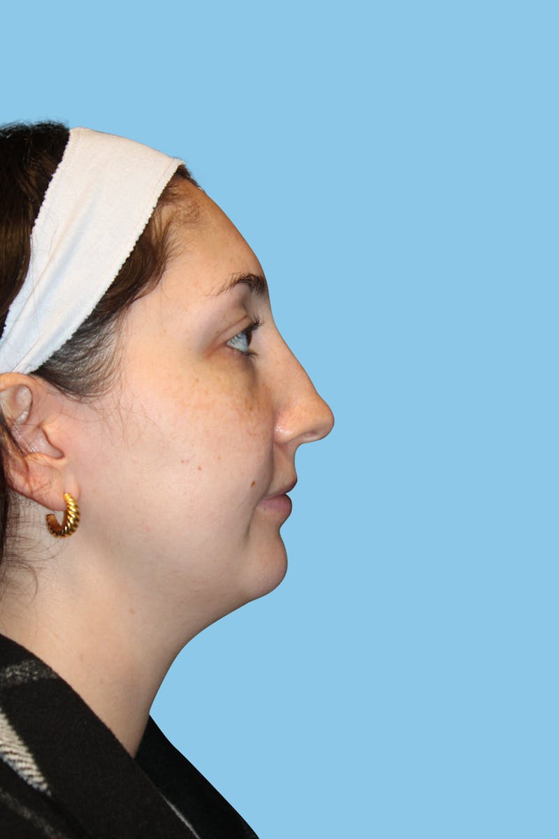 Rhinoplasty Before & After Gallery - Patient 154739 - Image 3