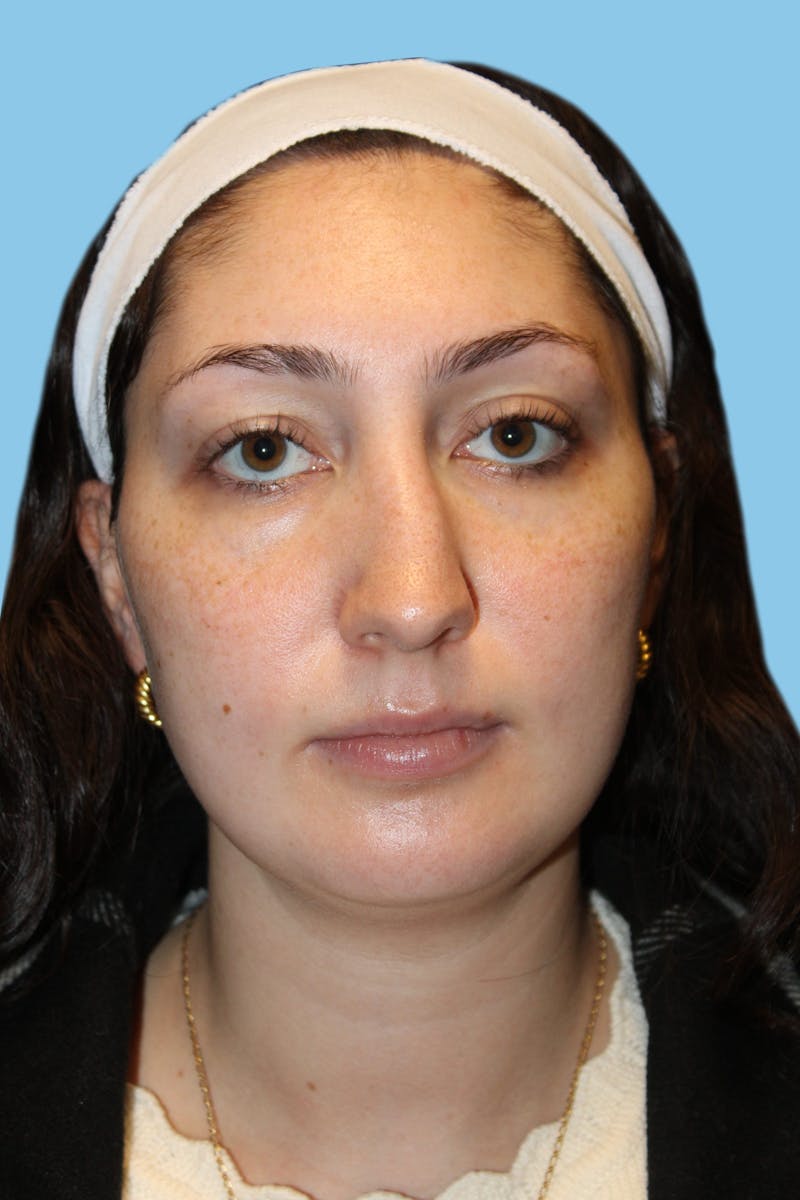 Rhinoplasty Before & After Gallery - Patient 154739 - Image 1