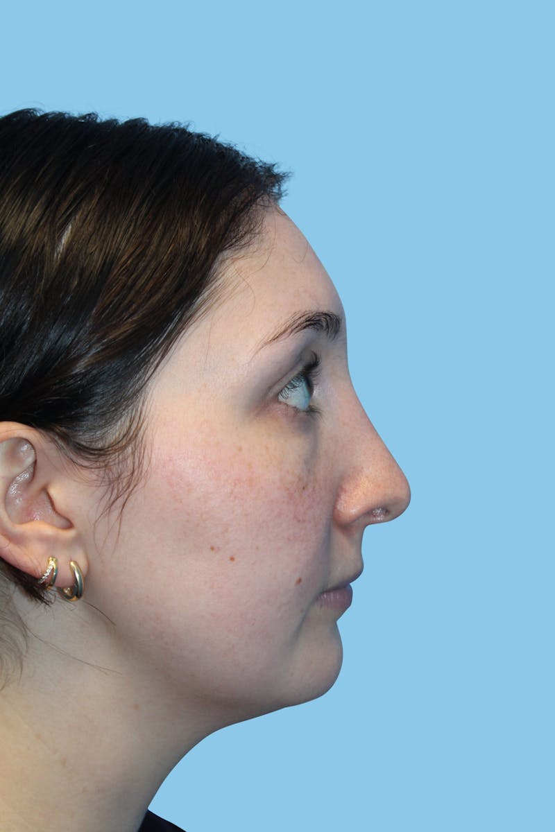 Rhinoplasty Before & After Gallery - Patient 154739 - Image 4