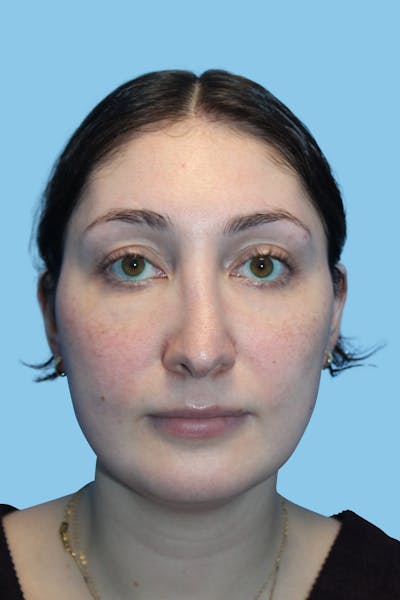 Rhinoplasty Before & After Gallery - Patient 154739 - Image 2