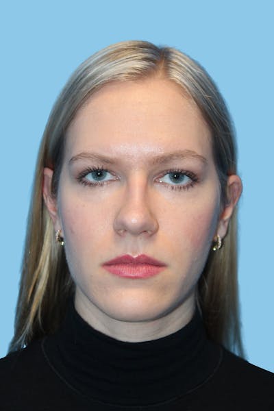 Revision Rhinoplasty Before & After Gallery - Patient 252611 - Image 2