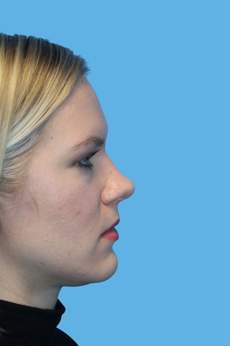 Revision Rhinoplasty Before & After Gallery - Patient 252611 - Image 4