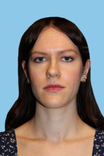 Revision Rhinoplasty Before & After Gallery - Patient 252611 - Image 1