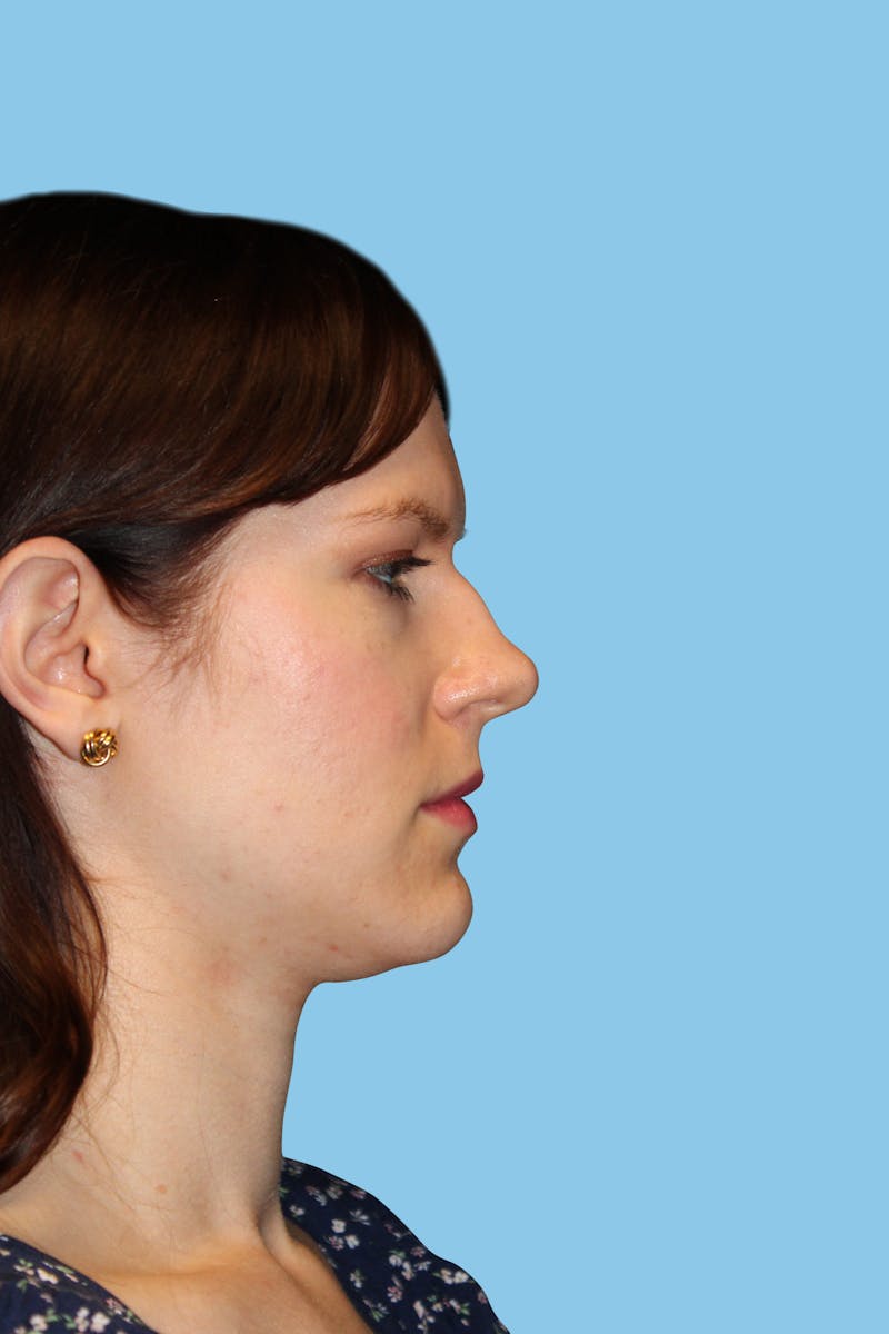 Revision Rhinoplasty Before & After Gallery - Patient 252611 - Image 3