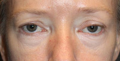 Eye Surgery Before & After Gallery - Patient 236279 - Image 1